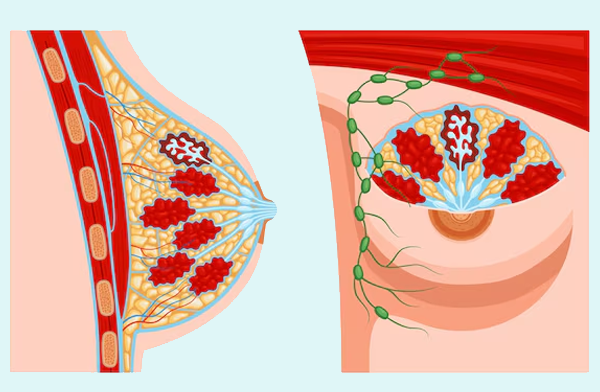 Breast Lump and Breast Cancer