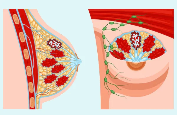 Breast Lump and Breast Cancer