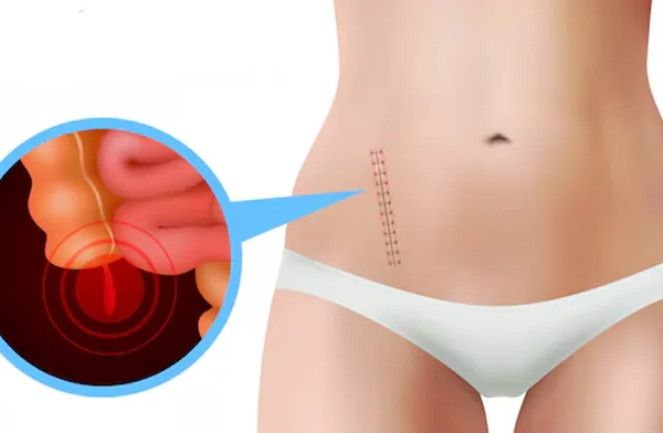 Appendicitis