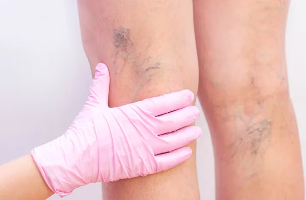 Varicose Veins