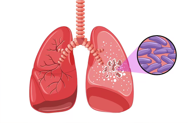 The Tuberculosis Myth